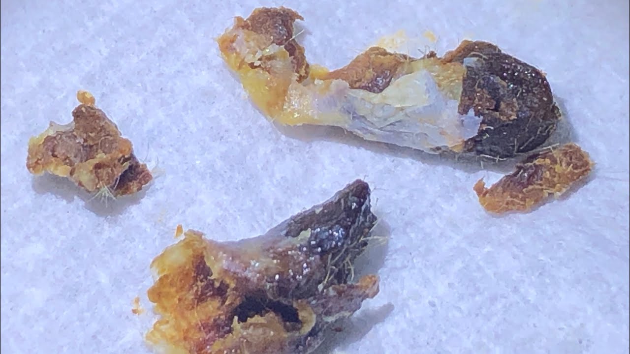 901 Dry Impacted Ear Wax & Dead Skin Plugs Extracted YouTube