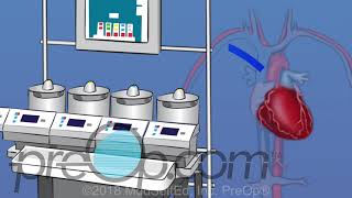 PreOp ®Coronary Artery Bypass Graft CABG