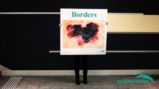 ABCDEs of Melanoma