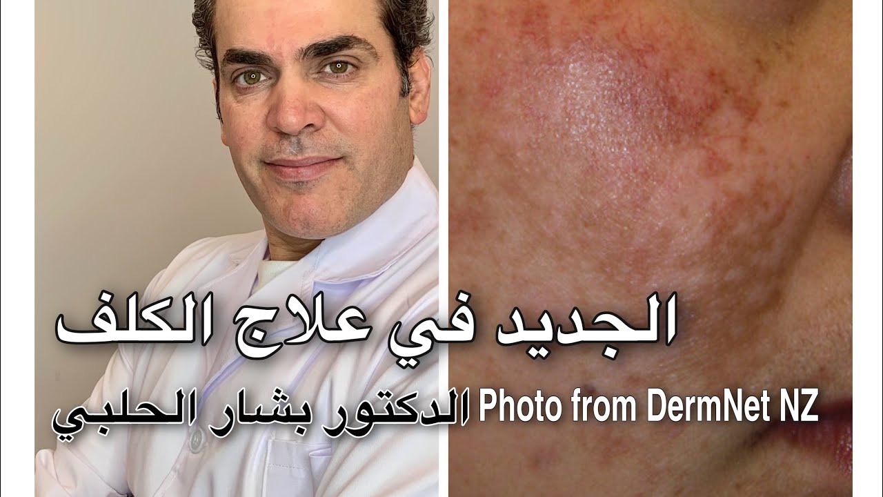 معلومات جديدة تساعدكم تتخلصوا من الكلف - طبيب جلد و تجميل