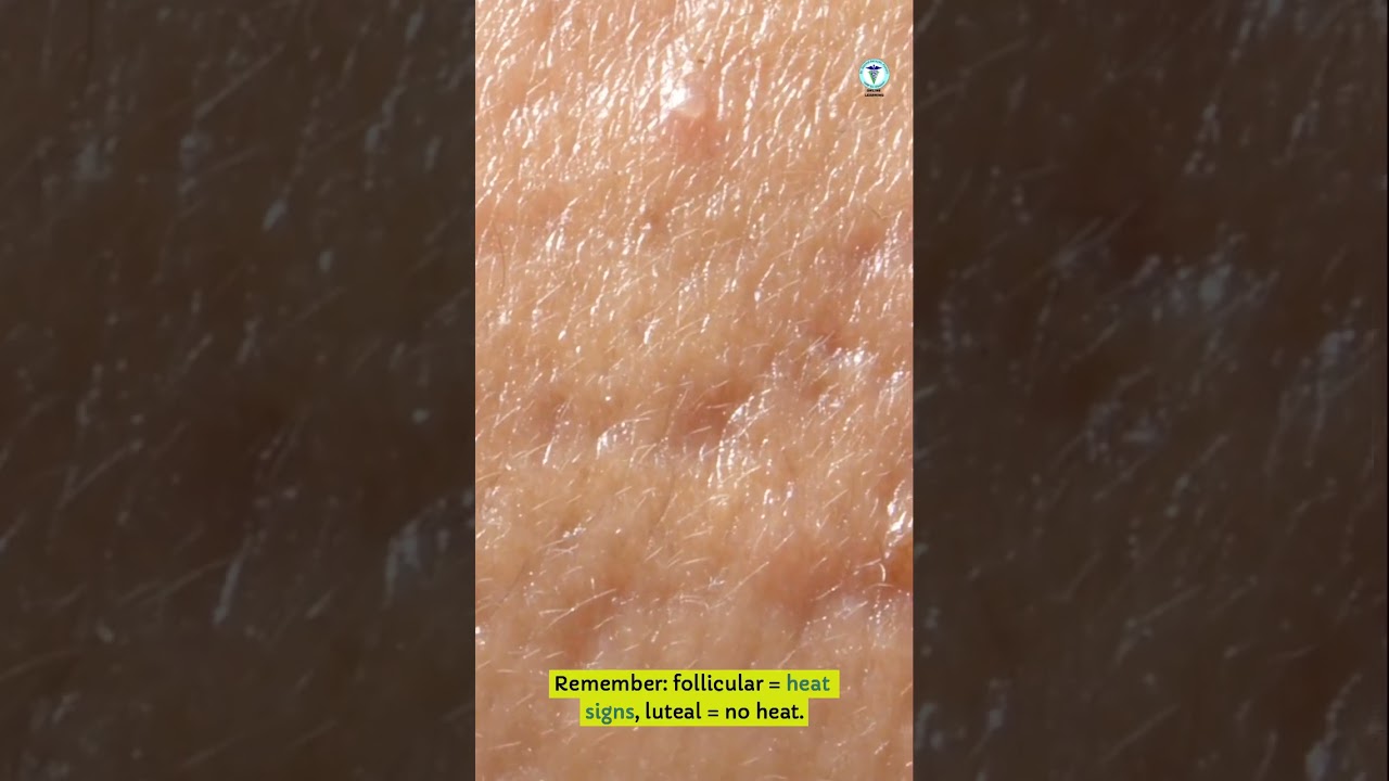 Follicular vs Luteal Cyst 🥚 Ovarian Cysts Simplified! | GNP Sir 