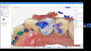 CEREC on DS Core