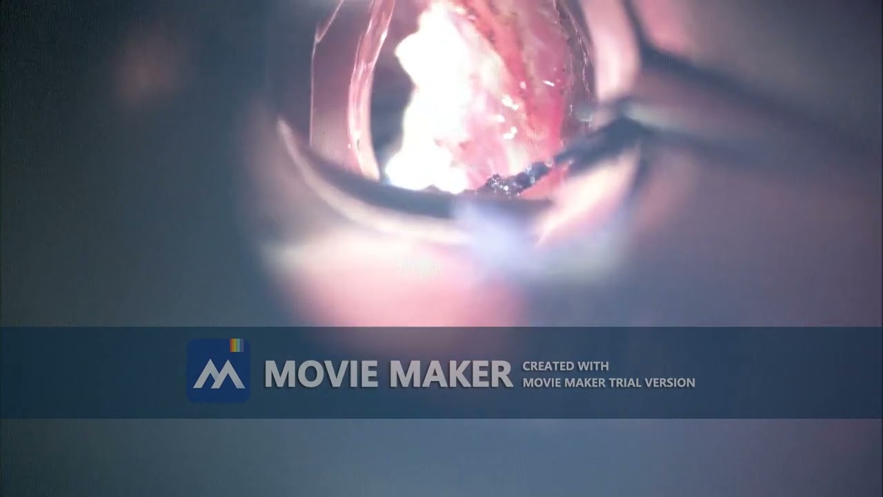 Excision of cancer of vocal cord. Right cordectomy using Co2 laser. T1N0M0 glottic carcinoma .