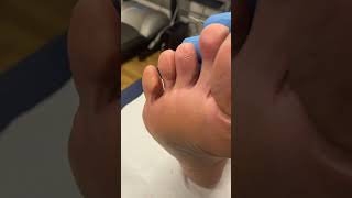 Transform your feet and step into comfort! 🌟 Watch as this podiatrist works wonders removing a