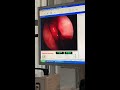 In-Office Out Fracture of the Inferior turbinates