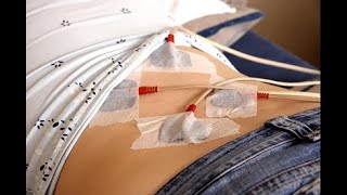 Electrical Stimulation for Pain Management and Hypersensitivity - January 23, 2021