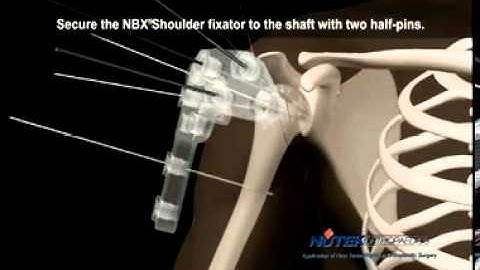 proximal humerus guided pinning