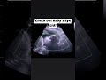 Can you see the baby&rsquo;s eye lid? So cool!! #jerbearimaging #eyelids #ultrasound #electiveultrasound