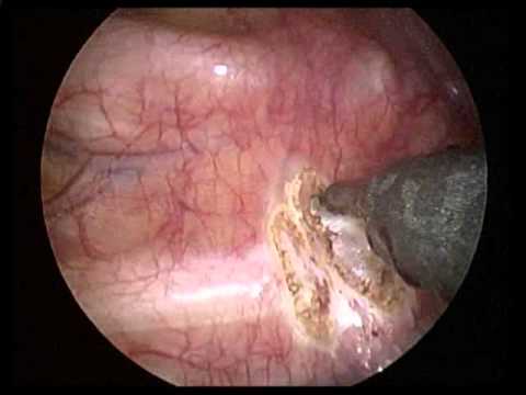 Thoracoscopic sympathectomy for hyperhidrosis - YouTube
