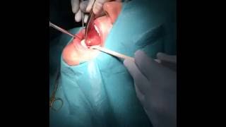 Implantation Live Vol 2. - Diamant-Dent Zahnklinik Ungarn Implantation Live Vol 2. - Diamant-Dent Zahnklinik Ungarn