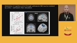 OHBM 2019 | Symposium | Multi - modal diffusion MRI, DBS and Computational Modeling to Underst…