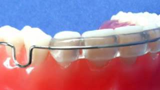 Acrylic Covered Labial Bow Description