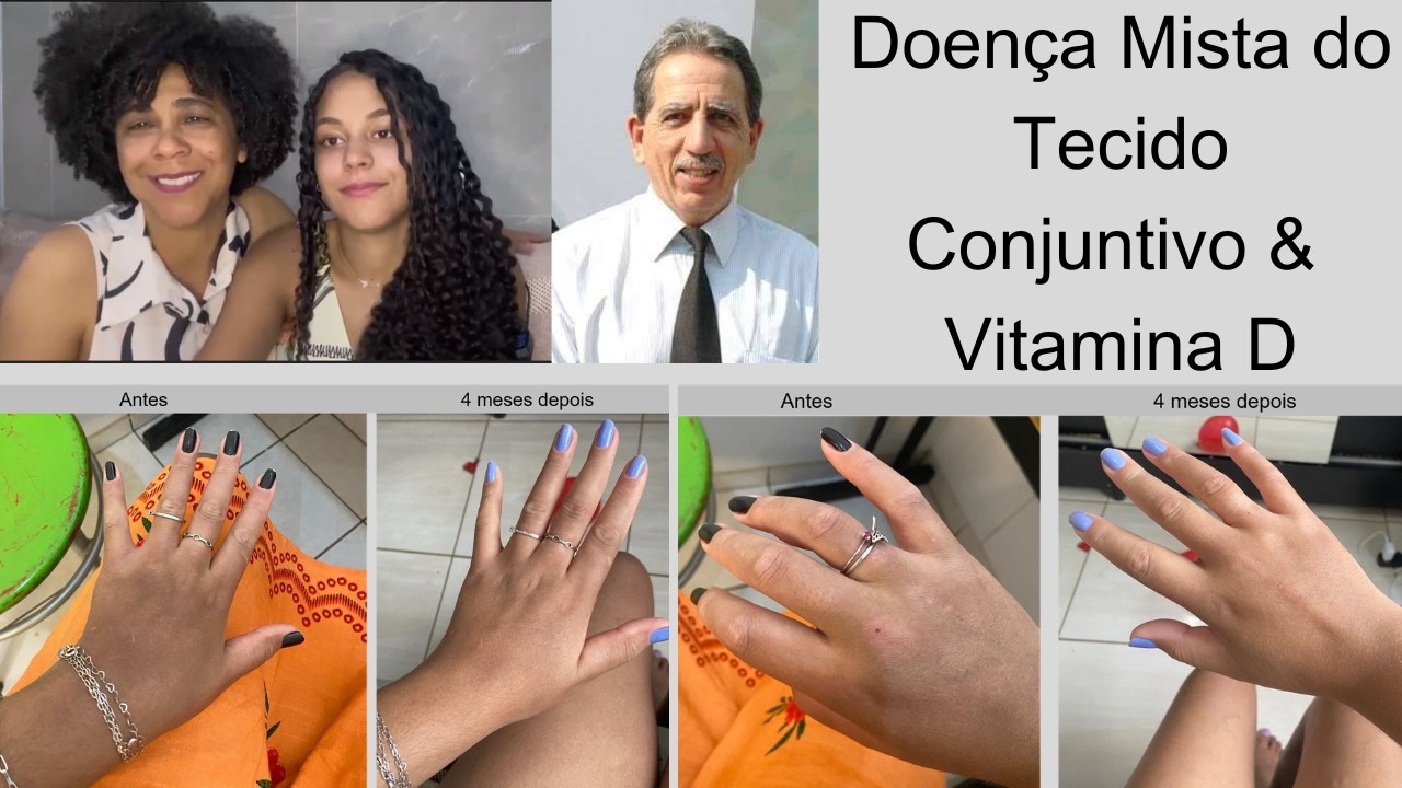 Ana Clara - Doença Mista do Tecido Conjuntivo #1161