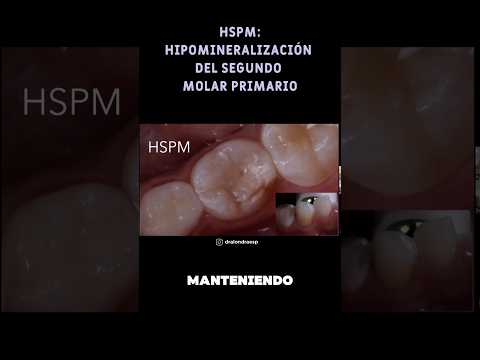 #hspm #odontologia #hipomineralizaciondeleegundomolarprimario