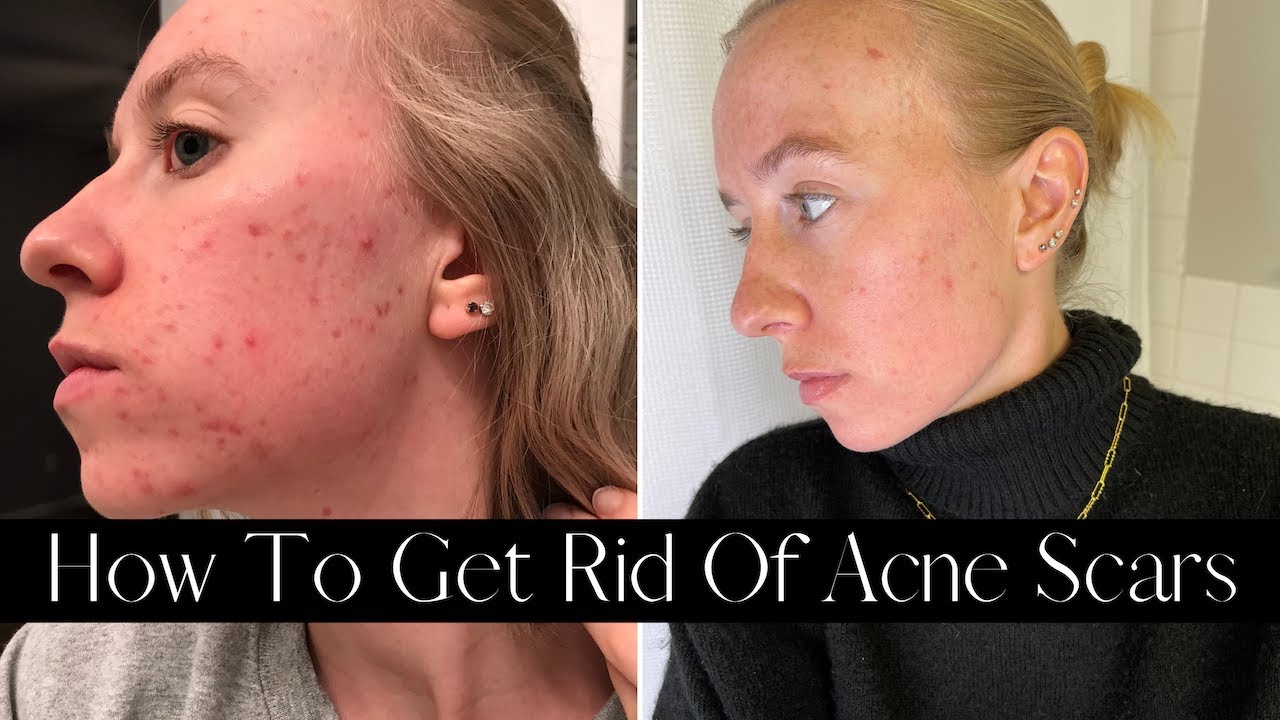 How To Get Rid Of Acne Scars | Reviewing Dr. Dennis Gross Products