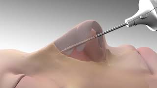 LATERA Animation for Patients With Nasal Wall Collapse