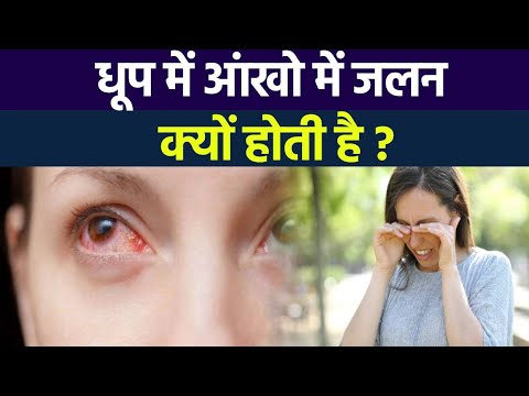 वीडियो: धूप से झुलसी पलकों का इलाज कैसे करें