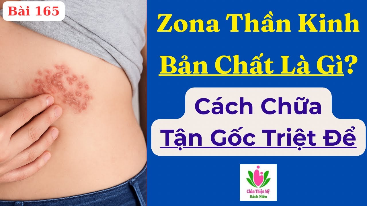Zona Thần Kinh (Bệnh Giời Leo) Bản Chất Là Gì? Cách Điều Trị Tận Gốc Tránh Biến Chứng Nguy Hiểm