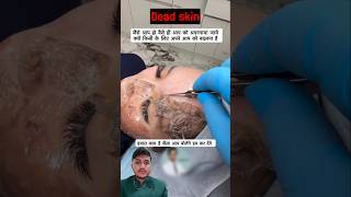 skin peel #skinpeeling #facialtreatment #deadskinremover