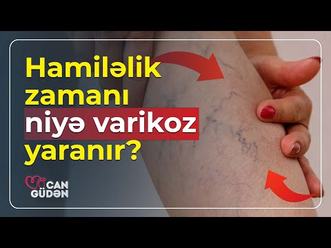 Hamiləlik zamanı varikoz əmələ gələ bilər? - Can Güdən (30.05.2023)