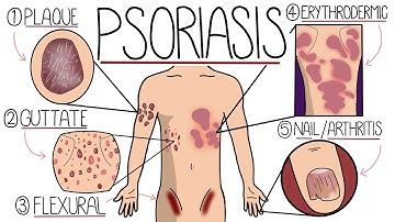 Psoriasis Explained Clearly - Including Types and Treatment