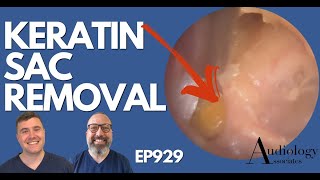 SKIN SAC REMOVED FROM EAR - EP929