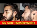 My Acne Transformation Before And After | Sahil Nagpal