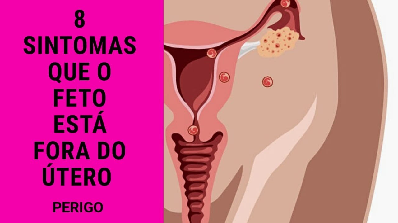 8 SINTOMAS de que o FETO está se DESENVOLVENDO FORA do ÚTERO (perigo ...