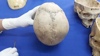 Skull - Introduction, Norma Verticalis, Norma Occipitalis..osteology