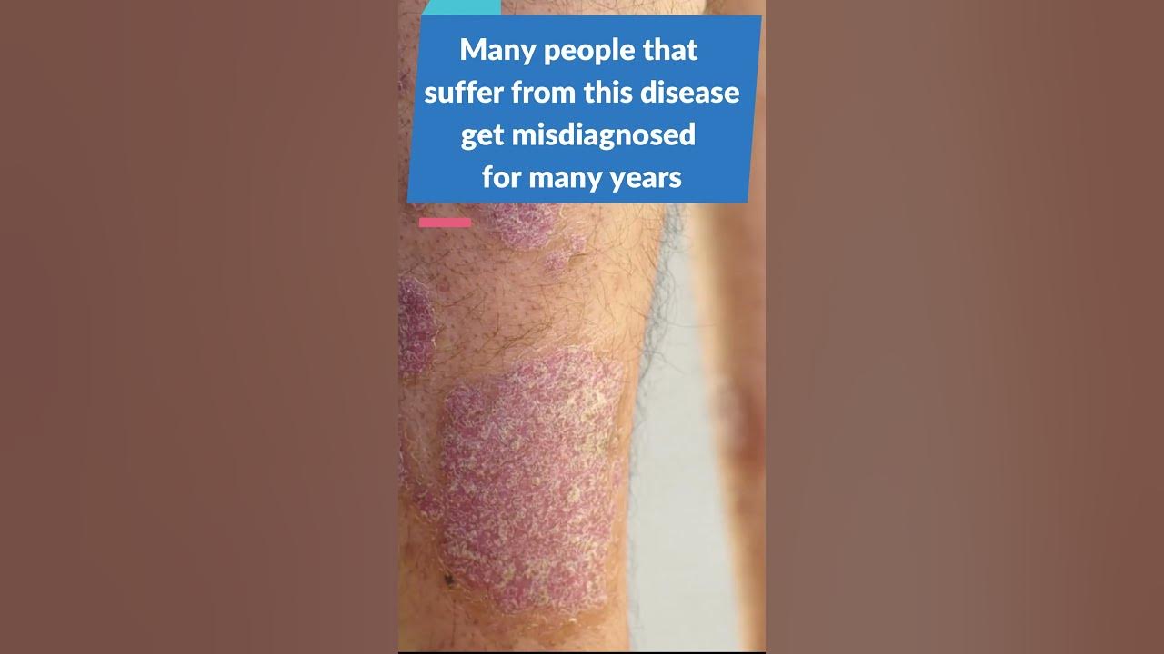 Can Psoriasis Cause Lupus