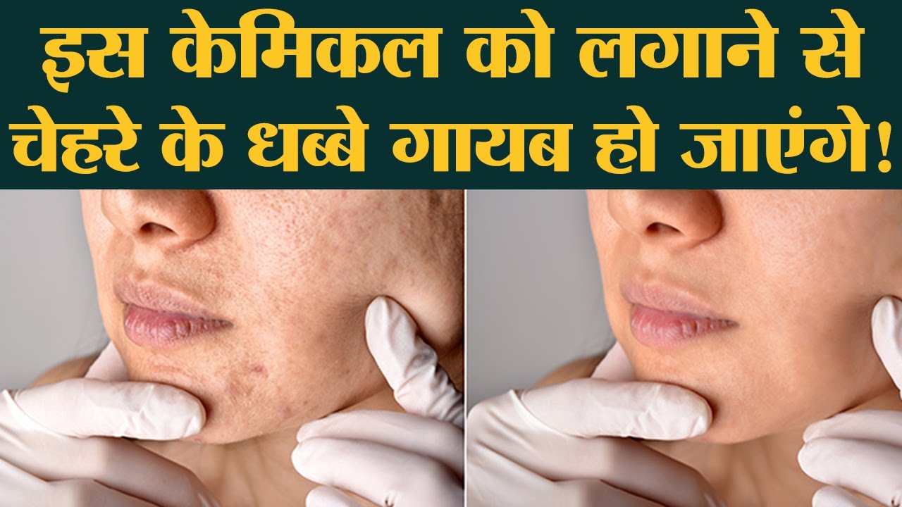 क्या होती है Chemical Peel जिससे Acne Scars गायब हो जाते हैं | Skin Tips| Sehat ep 234