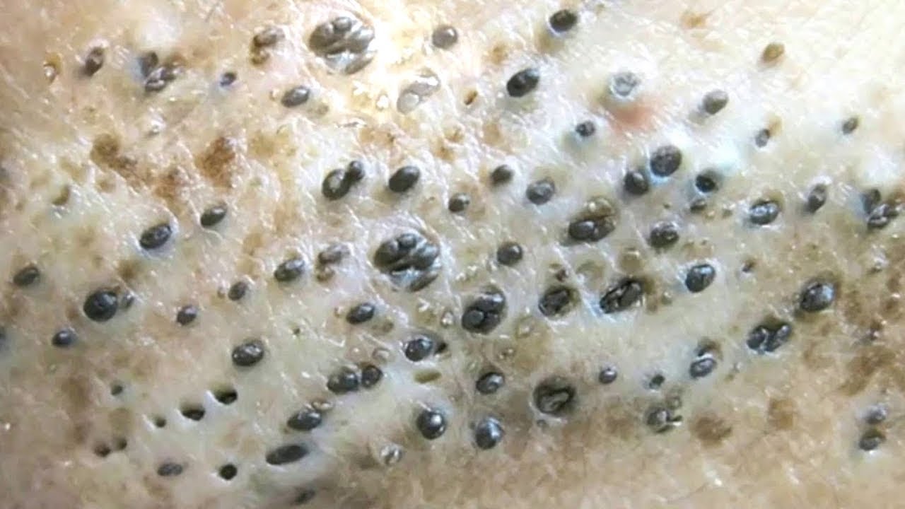 Relaxing Skincare Biggest Blackheads Removal YouTube Relaxing Skincare Biggest Blackheads Removal YouTube