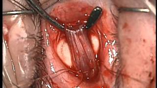 Eye surgery. Recession internal rectus. Хирург Хабибуллина Н.М., часть 2. за здоровье видео