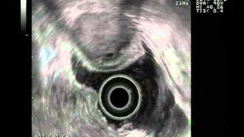 Stomach malignant GIST