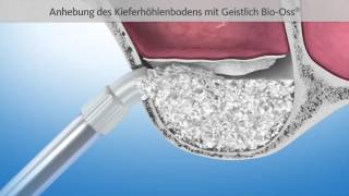 Knochenaufbau mit Sinuslift | Patienten Information