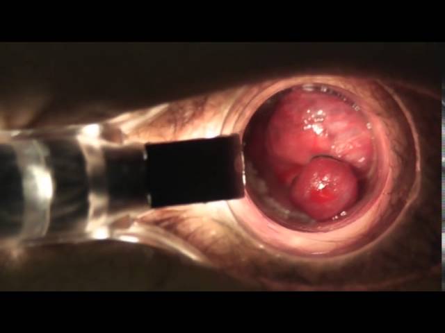 Лигирование латексными кольцами МЦ Аксон Балаково