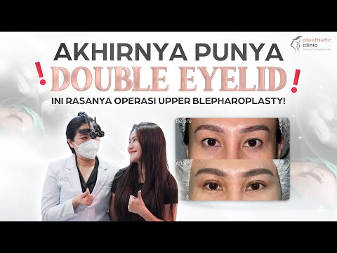 Video: Apa itu blepharoplasty bagian atas?