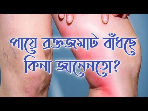 পায়ে রক্ত জমাট বাঁধা কি, কেন ও কিভাবে প্রতিরোধ করা যায় এবং মুক্তির উপায়। Blood Clots