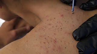 NO ADS Satisfying Blackhead & Acne Extraction 😮‍💨 Deep Pore Cleaning | Real Treatment