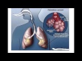 mesothelioma Mesothelioma pleural malignant pleura factors risk
diagnosis surviving kraus alternative paul way