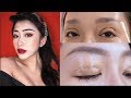 MY SCARLESS DOUBLE EYELID (STITCHING) SURGERY RECOVERY