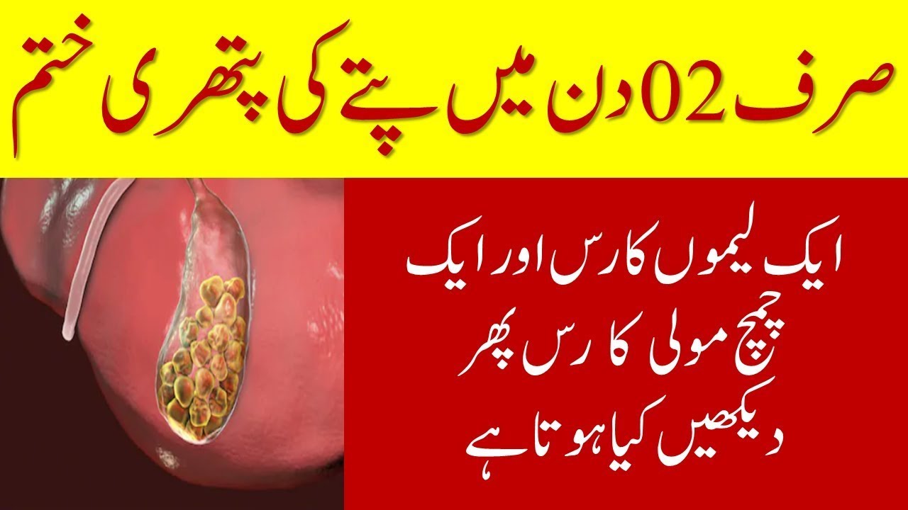 Pitte ki pathri ka ilaj | gall bladder stone treatment in urdu