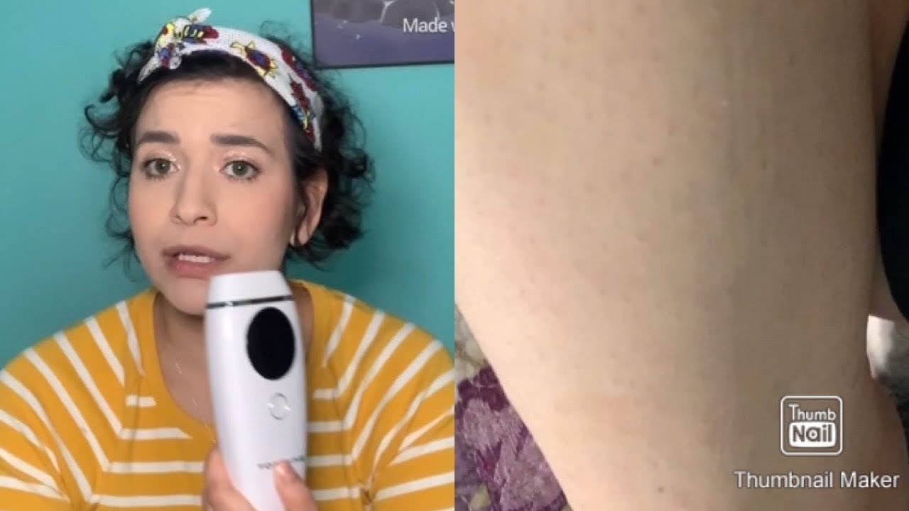AMAZON 60 DOLLAR AT HOME LASER HAIR REMOVAL! KENZZI DUPE YouTube