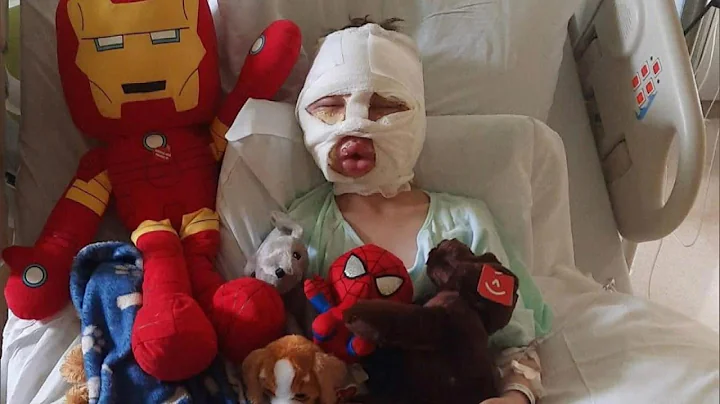 Bully’s Burns Left 6-Year-Old Hospitalized, Parents Say - DayDayNews