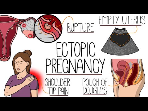 Ectopic Pregnancy Explained Clearly