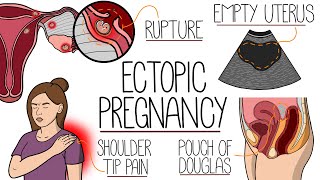 Ectopic Pregnancy Made Easy