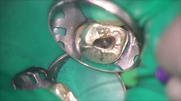 Most challenging step in root canal treatment?? Hyflex EDM glide path vs. OneG