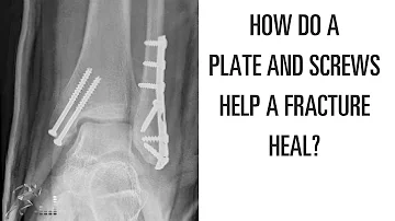 Can bones be replaced with titanium?