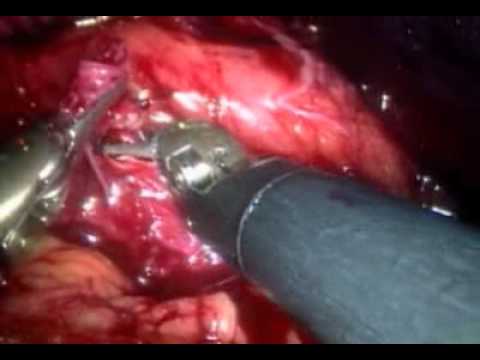 am i how not robot bypass a to Robot  Bypass Aortofemoral  YouTube Assisted Laparoscopic