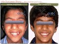 Part 4 | Dental Braces Before and After | Cosmetic Dental Treatment in Kolkata | Orthodontist